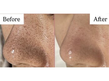 シェリー トウキョウ 西葛西店(Cherie Tokyo)/黒ずみ毛穴卒業◎/西葛西/行徳