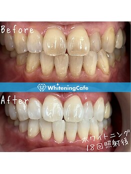 ホワイトニングカフェ 和歌山ガーデンパーク店(WhiteningCafe)/24分×2回照射/6回来店/50代女性