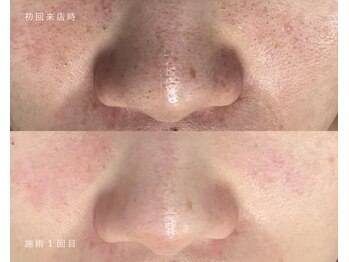 ルポ 鶴見(Repos)の写真/【黒ずみ毛穴・角栓・皮脂撃退】汚れを洗い流し、毛穴引き締め★小鼻の乾燥も同時解消★