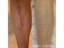 オウジエステサロン(OJIエステサロン)/40代女性　プロセル2回