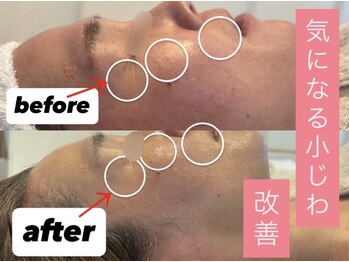 イイプラス(ii+)の写真/年齢による肌悩みにアプローチ!ダウンタイムなしの本格ケア◎