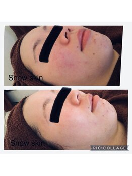スノースキン(Snow skin)/【乾燥肌なのにニキビ肌、、、】