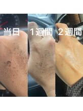 ピュア 川越店/光フェイシャル(手の甲)