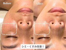 ピュアノア 垂水店/肌質改善フェイシャル　神戸垂水