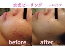 ミレット(Miretto)/【ニキビ改善】水光ピーリング