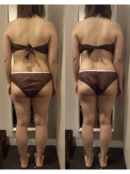 マロー(Mallow)/キャビテーションのビフォアフ