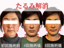 小顔矯正整体の回数を重ねる事で、より確実な小顔へ導きます！