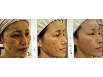 セラビシャン/before→after