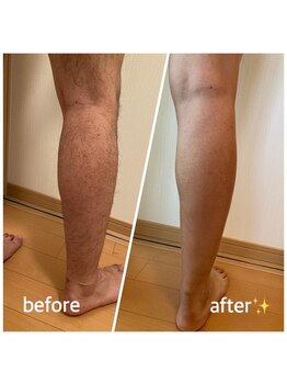 セルフ脱毛サロン SELFMADE イオンタウン仙台泉大沢店【3/29 NEW OPEN(予定)】 /【ビフォーアフター】セルフ脱毛