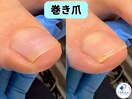 巻き爪矯正は専門店へ●