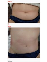 スキャニング@ラボエステ/ロシア機器血管拡張脂肪分解導入