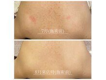 ビジュープラス 水戸店(Bijou+)の雰囲気（大人気★ボディ肌質改善/[途中経過]背中・お尻・腕・デコルテ等）