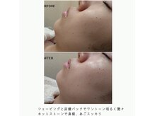 美ハッピーの雰囲気（ホットストーンとシェービングと炭酸パックで、むくみ改善艶々）