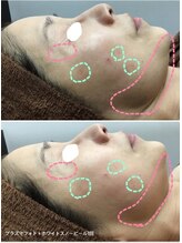 プリマプリート 各務原店/プラズマフォト&スノーピール