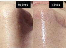 ニコラフ(Nico laugh)/毛穴洗浄　ビフォーアフター