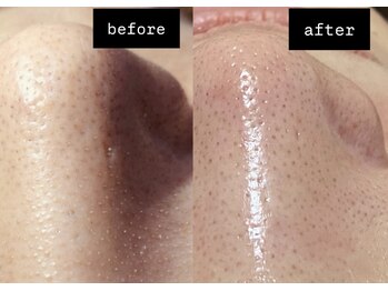 ニコラフ(Nico laugh)/毛穴洗浄　ビフォーアフター