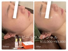 エステサロン ジュエル 高松レインボー店(JEWEL)/ララピール