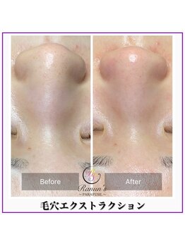 ラナン パラフューズ(Ranun's PARAFUSE.)/毛穴ビフォーアフター(1)