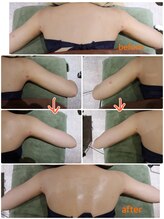 フランジパニ/美容吸引後ケア　