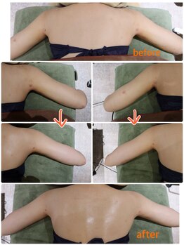 フランジパニ/美容吸引後ケア　