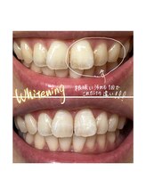 ボンダイボディー(Bondi Body)/かなりの効果ホワイトニング