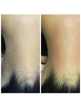 ケーナイン(K_nine)/襟足脱毛