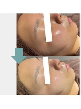 レベンディス(LEVENDIS)/ハーブピーリング