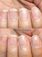 マリーロール 梅田店(Marie Laure)/深爪矯正/自爪育成/自爪風