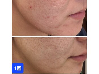 ビハダ(BeHADA)/REVIハーブピーリング