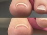 巻き爪さよならコース～クリア～【FOOT】