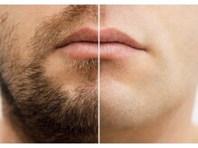 サロンリアンジュ ひたちなか店(Salon Liange)/毎日の髭剃りにおさらば◇顔脱毛