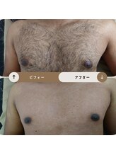 ジュゴン(Dugong)/胸の脱毛（Before＆After）
