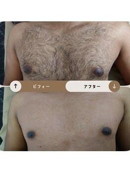 ジュゴン(Dugong)/胸の脱毛（Before＆After）