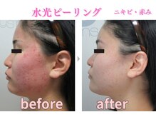 ミレット(Miretto)/【ニキビ・赤み】水光ピーリング