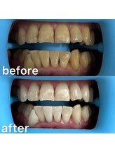 ホワイトニングセンター 富山二口店/富山　二口町ホワイトニング