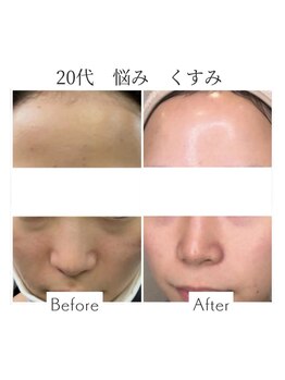 ファニービー 吹田店/20代 くすみ 12ヶ月で改善