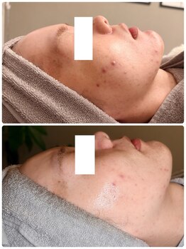 ペルル(Perle)/エクソソームハーブピーリング