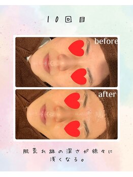 リリアン(lirien)/毛穴/毛穴ケア/毛穴洗浄/駒込