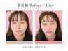 【美容鍼が初めての方】 鏡を見るたび気になるフェイスライン・ほうれい線に