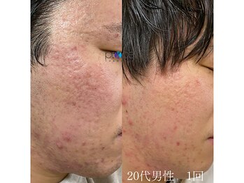 オウジエステサロン(OJIエステサロン)/40代女性　プロセル2回
