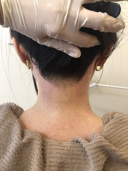 サクラ 心斎橋店(SAKURA)/うなじワックス脱毛