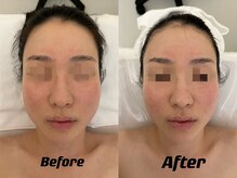 ナラビューティー(NARA BEAUTY)/ハイパーナイフ×コルギ