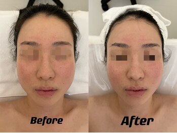 ナラビューティー(NARA BEAUTY)/ハイパーナイフ×コルギ