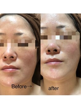 サロンシャイン(Salon Shine)/超音波フェイシャル１回４０代