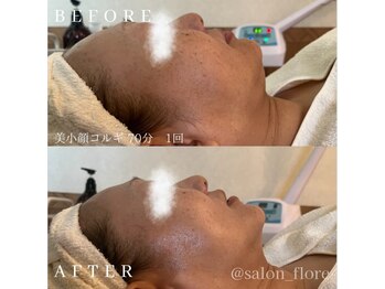 フローレ 平針店(Flore)/むくみスッキリ《美小顔コルギ》