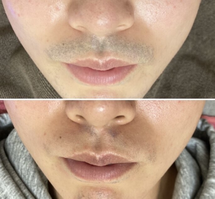 【人気No.２★】ヒゲ剃り不要!剃り負け肌荒れ卒業!ヒゲ脱毛初回\5500