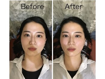 もりわき骨盤鍼灸整骨院 梅田院/電磁美容鍼後の変化