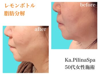 カピリナスパ(Ka.Pilina Spa)/レモンボトル before⇒after
