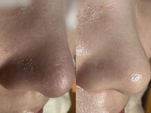 サラグランデ(Sara Grande)/毛穴コース１回でごっそり！