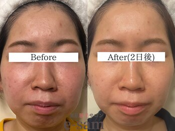 イーサム 高槻摂津富田店(e-sam)/炭酸パック